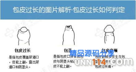 昌吉新和县消除男性朋友对包手术的疑问